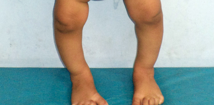 Genu Varum Bow Legs